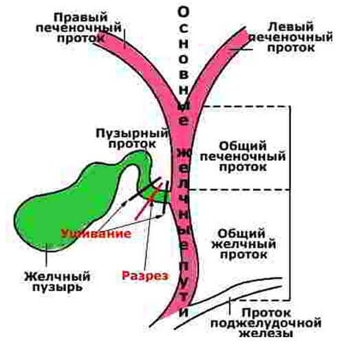 желчные протоки после удаления желчного пузыря схема